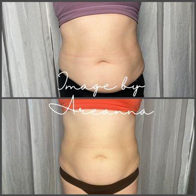 Body contouring works to tone and shape your body without surgery!