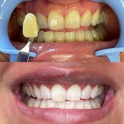 3 sessions of teeth whitening