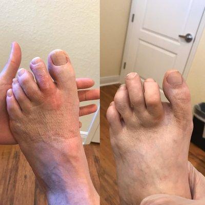 Severe Hammertoe and Ligament rupture Correction - Before and After