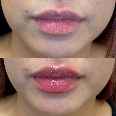 A touch of lip filler here and there provides symmetry, hydration, and extra juiciness.  We are obsessed with these lips!