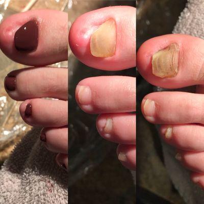 Painful,fungus infected,damaged nails. Caused by repeated trauma to the nails. Significant improvement in one appointment.