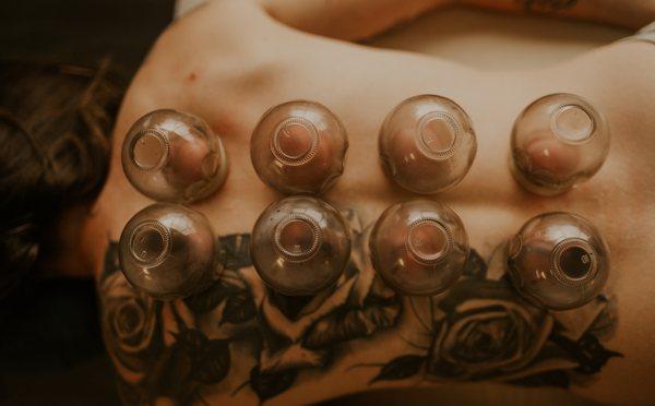 Cupping therapy at Galen Wilson Acupuncture, San Luis Obispo