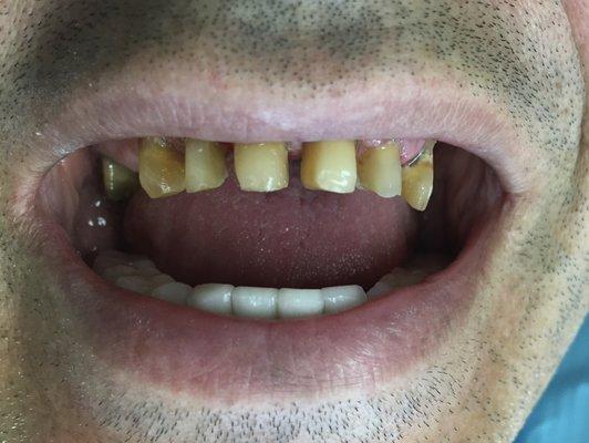 Removed and replaced unnatural old crowns with dark line at gingival margin