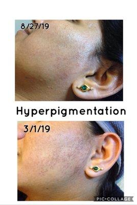 Hyperpigmentaion Treatment by Microneedling Folsom CA