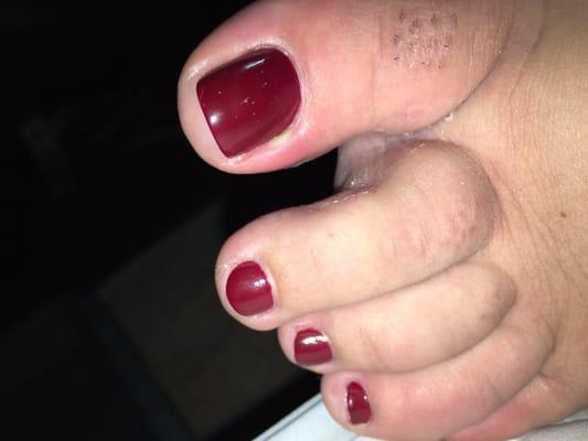 Big toe infected and skin peeling!