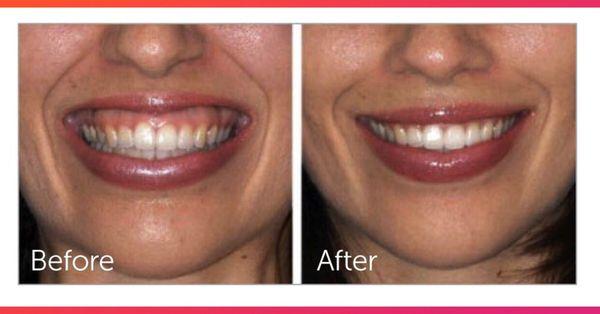 Correct Gummy Smile with Botox