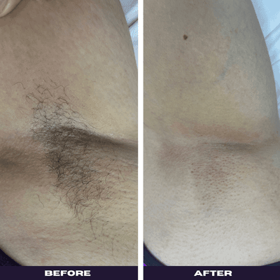 Before and after underarm wax