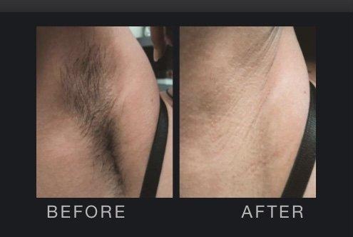 Laser Hair Removal