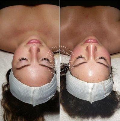 Beautiful Hydrafacial   &