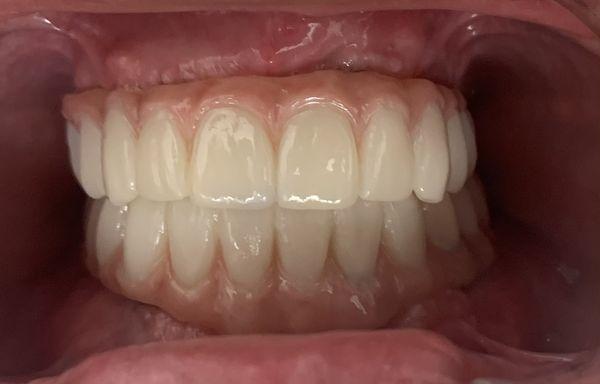 Upper and lower ALL ON 4 - fixed dentures with implants