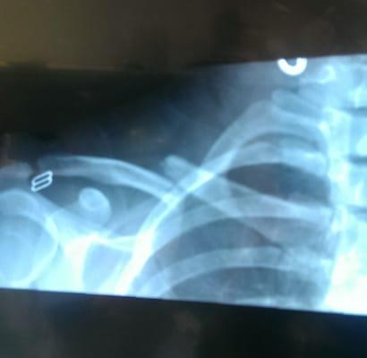 Broken collar bone that Gritman ER said didn't need surgery to reconnect the bone ends to heal properly.