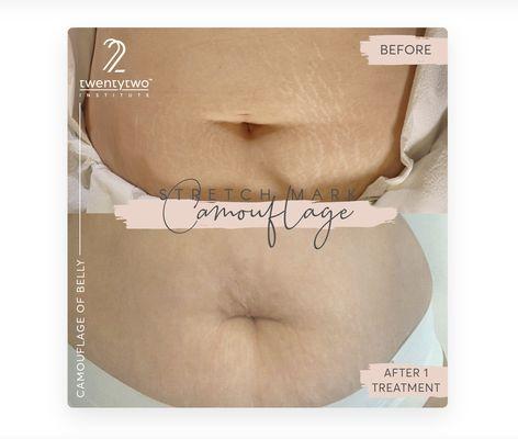 Embrace Your Beautiful Journey: Transforming Stretch Marks into Stories of Strength and Resilience.