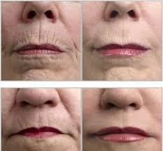 Microneedleing