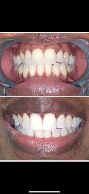 Teeth whitening book appt today