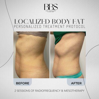 2 sessions of radiofrequency and mesotherapy