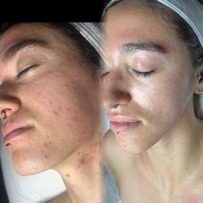 After 3 months of Acne clear skin Program !