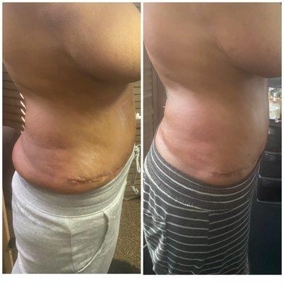 Post op Maintenance in essential. Ask about our perfect post op package. Lymphatic drainage Las Vegas .