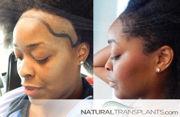 Natural Transplants Hair Restoration Clinic