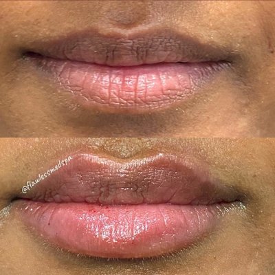 Natural looking lip enhancement