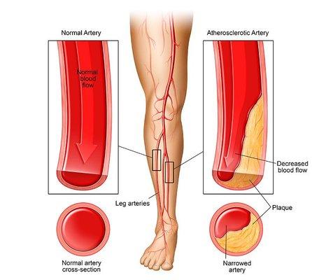 Healthy artery vs Narrowed artery