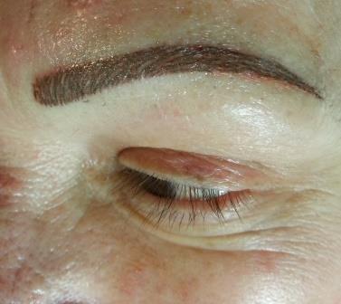 Brow correction after 1 session