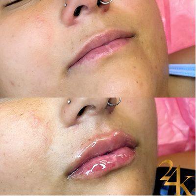 Hyaluron Pen Lip Filler Before & After