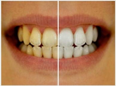 Teeth Whitening Carson, CA