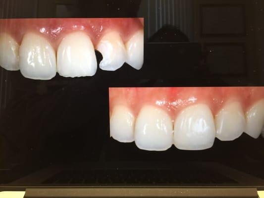 Before and after photos of front and side tooth