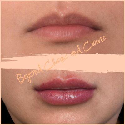 Lips enhancement