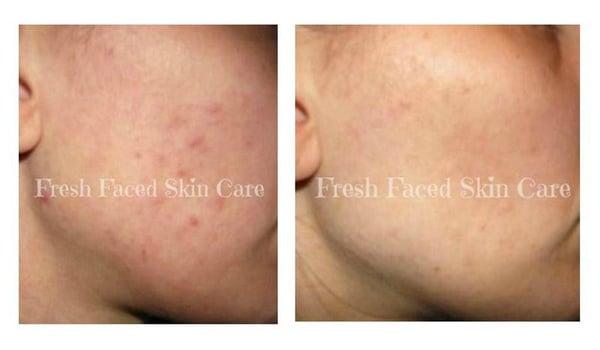 Inflamed Acne with Pigmentation