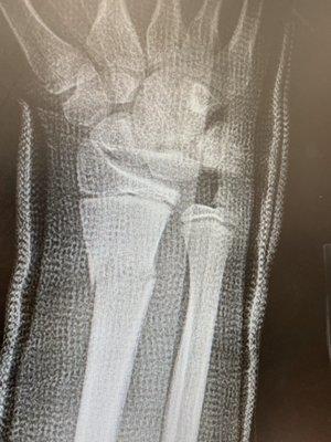 The "before" x-rays of my sons 2 wrist fractures