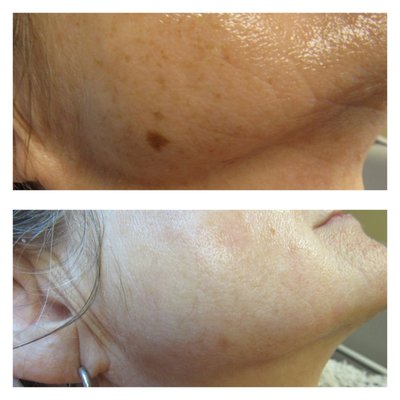 Skin rejuvenation. Microneedling./Dermapen.