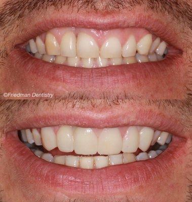 Dr. Matt was able to provide this patient with a "mock-up" of how their smile could look prior to starting any treatment.