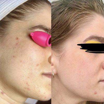 Clear Skin Before and Afters: Acne Bootcamp!