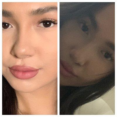 rhinoplasty before and after (sorry for bad lighting)