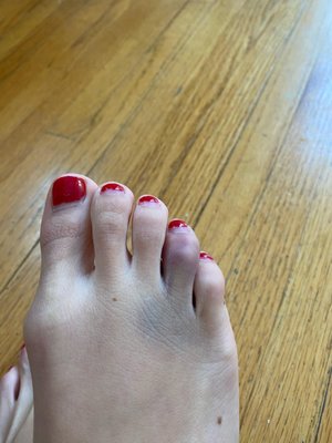 Damage to my toe from shelf