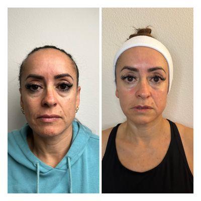 Six-week Sculptural Face Lifting results. My client received one treatment for six weeks, and these are the magical results!