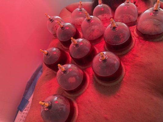 Hijama