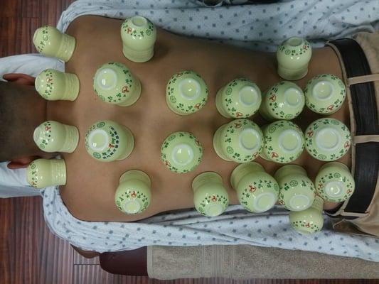 Cupping