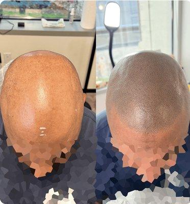 Scalp micropigmentation for men's hair loss. Before and after treatments by Edge Scalp Ink in Bethesda, Maryland.