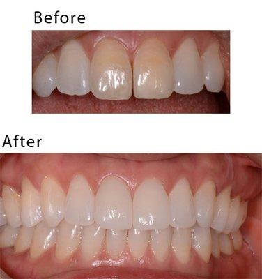 Two front discolored teeth were restored with Cerec crowns. It took 2 hours. They are beautiful and strong.