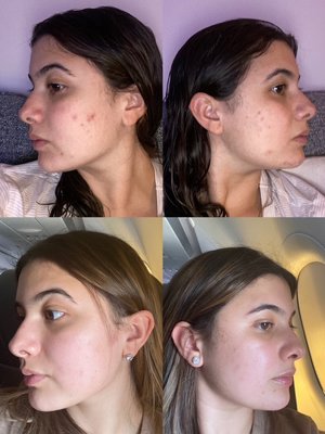 After two acne treatments facials