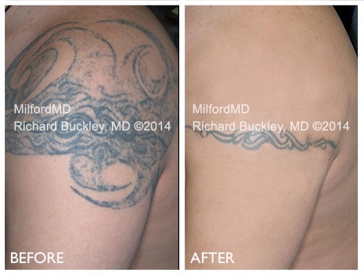 Before and After Tattoo Cleaning - MilfordMD