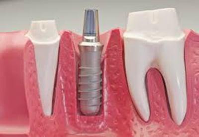 Dental Implants