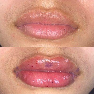 Hyaluronic acid lip filler before and After