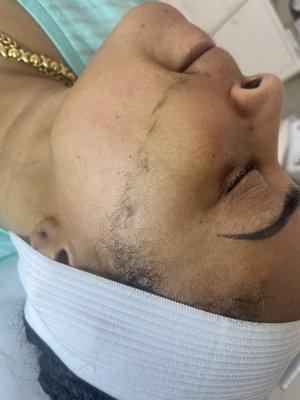 DERMAPLANE Facial