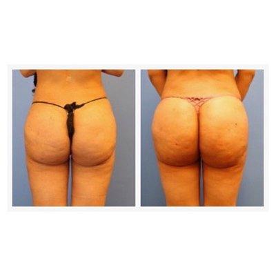 Sculptra Butt Lift