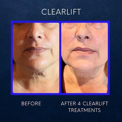 Clear Lift Neck!