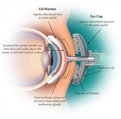 Meibomian Gland Dysfunction