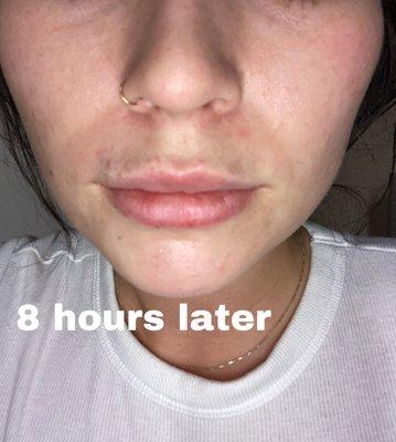 8 hours after restylane kysse